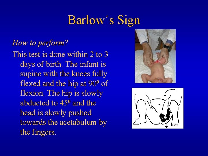 Barlow´s Sign How to perform? This test is done within 2 to 3 days