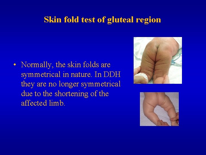 Skin fold test of gluteal region • Normally, the skin folds are symmetrical in