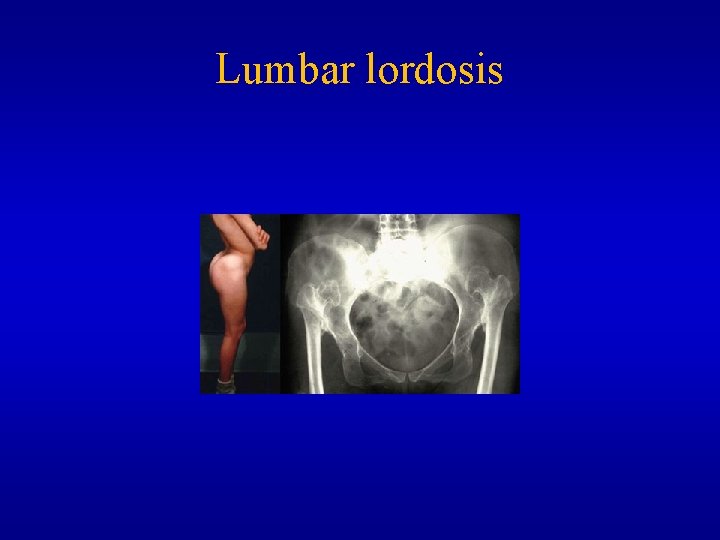 Lumbar lordosis 