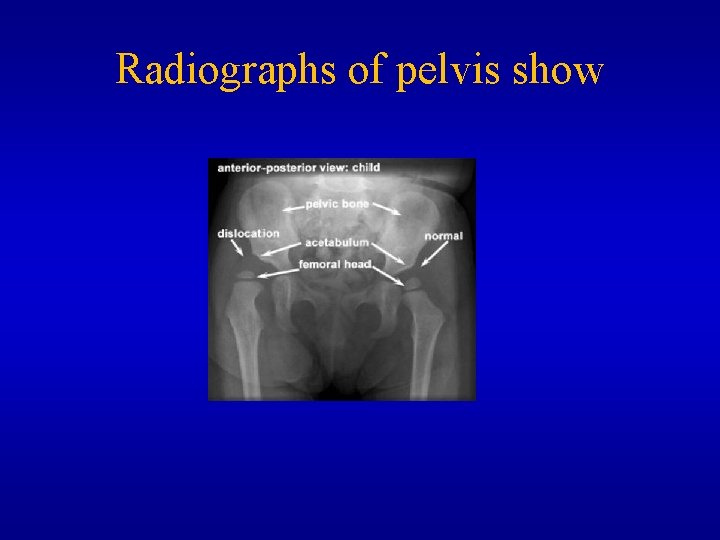 Radiographs of pelvis show 