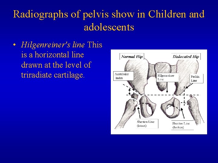 Radiographs of pelvis show in Children and adolescents • Hilgenreiner's line This is a