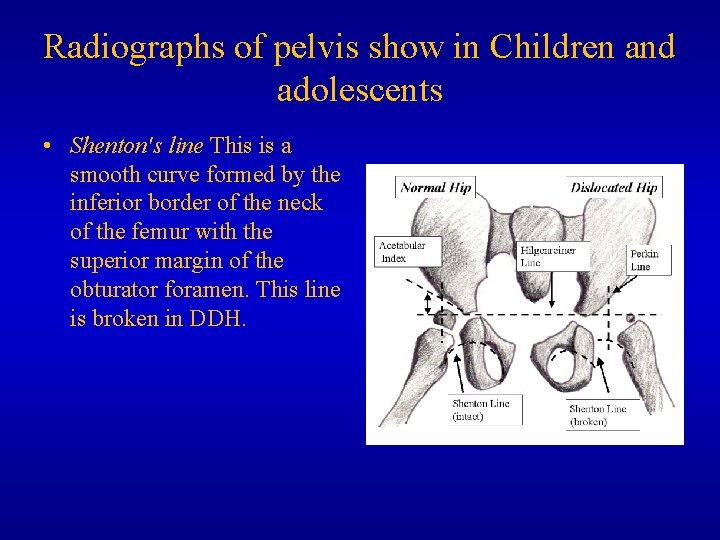 Radiographs of pelvis show in Children and adolescents • Shenton's line This is a