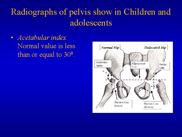 Radiographs of pelvis show in Children and adolescents • Acetabular index Normal value is