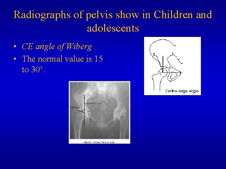 Radiographs of pelvis show in Children and adolescents • CE angle of Wiberg •