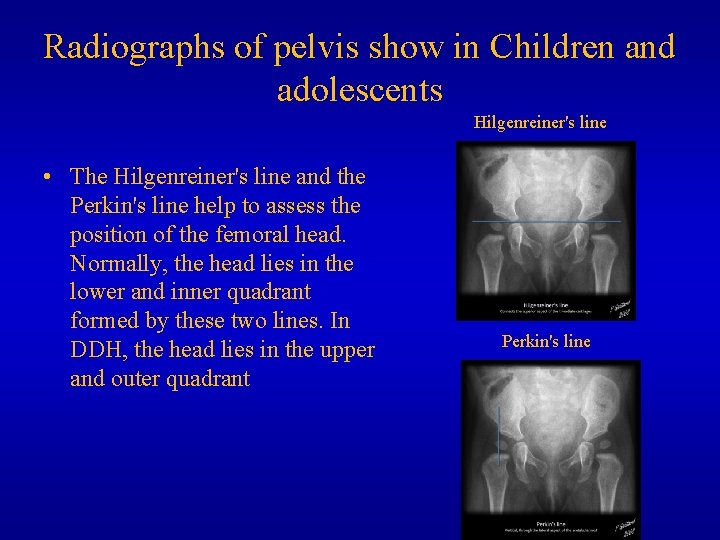 Radiographs of pelvis show in Children and adolescents Hilgenreiner's line • The Hilgenreiner's line