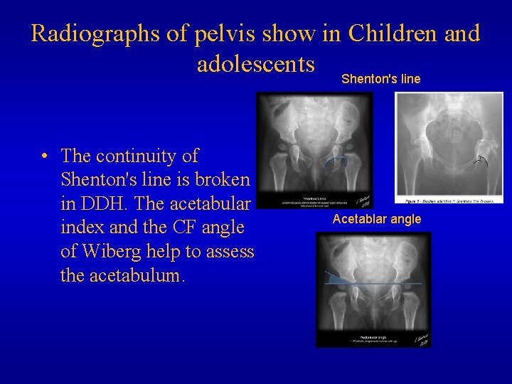 Radiographs of pelvis show in Children and adolescents Shenton's line • The continuity of