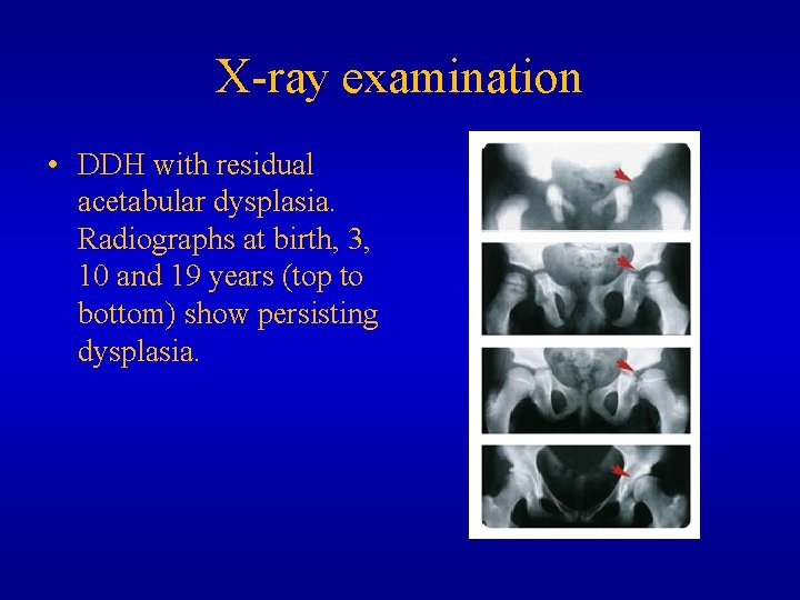 X-ray examination • DDH with residual acetabular dysplasia. Radiographs at birth, 3, 10 and