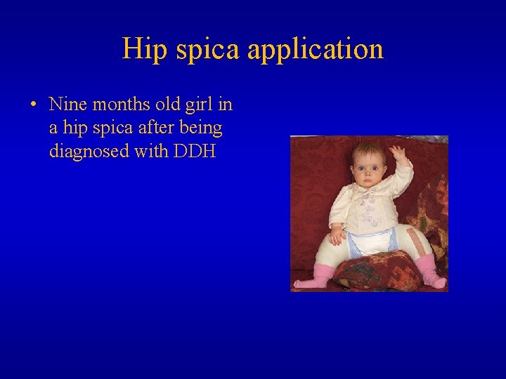 Hip spica application • Nine months old girl in a hip spica after being