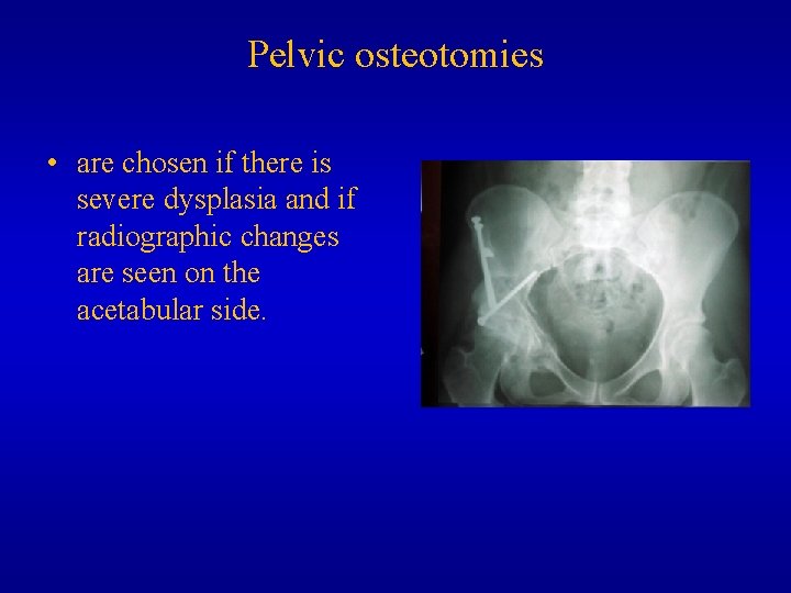 Pelvic osteotomies • are chosen if there is severe dysplasia and if radiographic changes