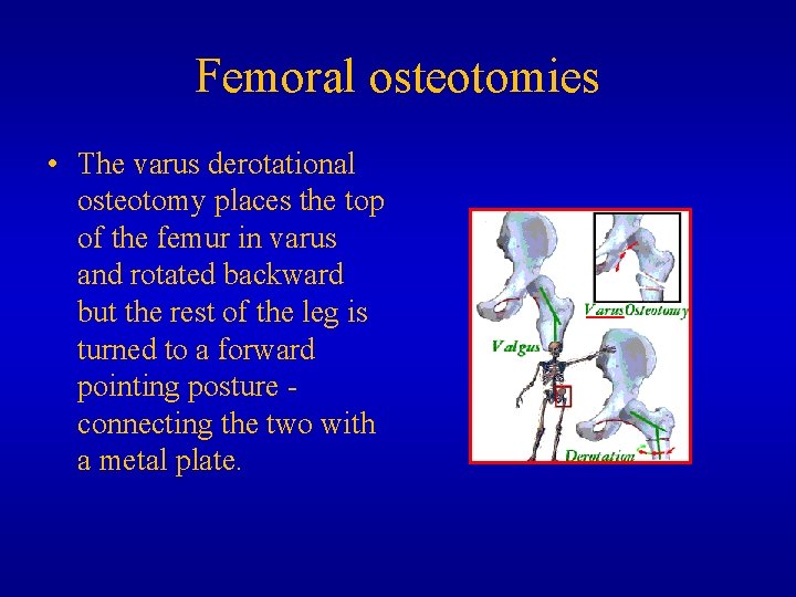 Femoral osteotomies • The varus derotational osteotomy places the top of the femur in
