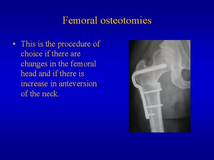 Femoral osteotomies • This is the procedure of choice if there are changes in