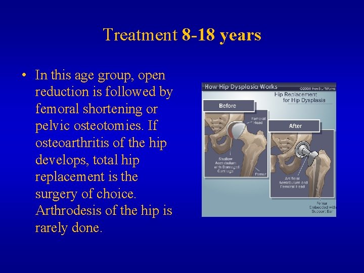 Treatment 8 -18 years • In this age group, open reduction is followed by