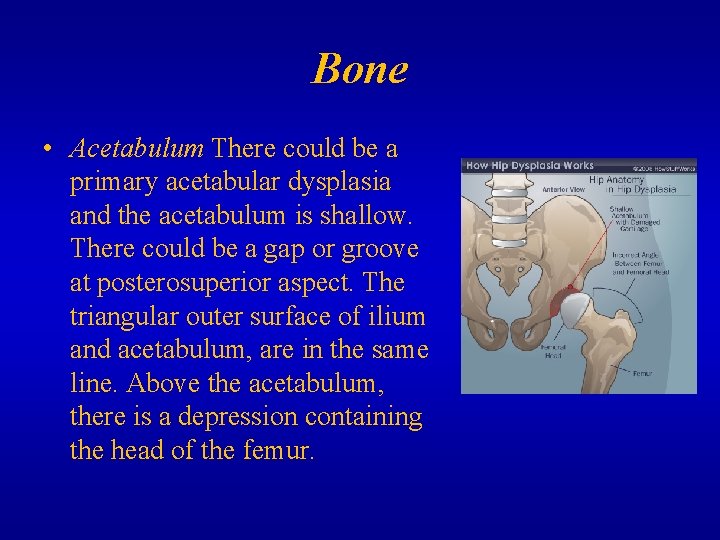 Bone • Acetabulum There could be a primary acetabular dysplasia and the acetabulum is