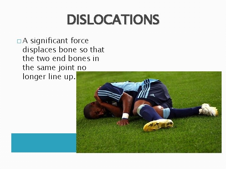 DISLOCATIONS �A significant force displaces bone so that the two end bones in the