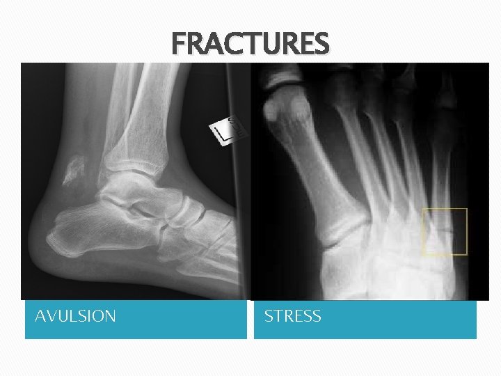 FRACTURES AVULSION STRESS 