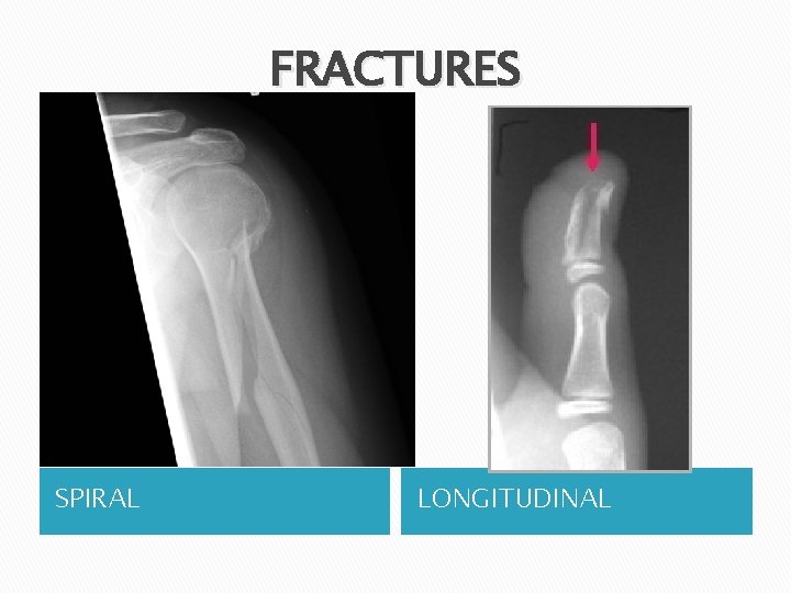 FRACTURES SPIRAL LONGITUDINAL 