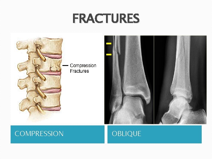 FRACTURES COMPRESSION OBLIQUE 