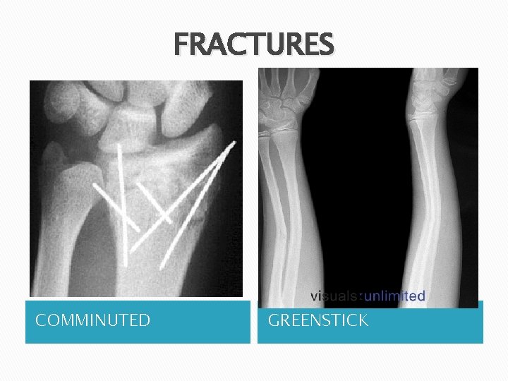 FRACTURES COMMINUTED GREENSTICK 