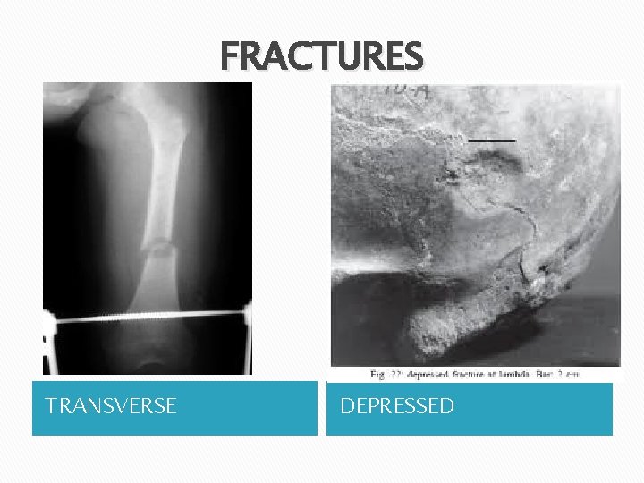 FRACTURES TRANSVERSE DEPRESSED 