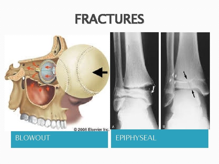 FRACTURES BLOWOUT EPIPHYSEAL 