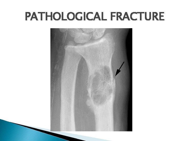 PATHOLOGICAL FRACTURE 