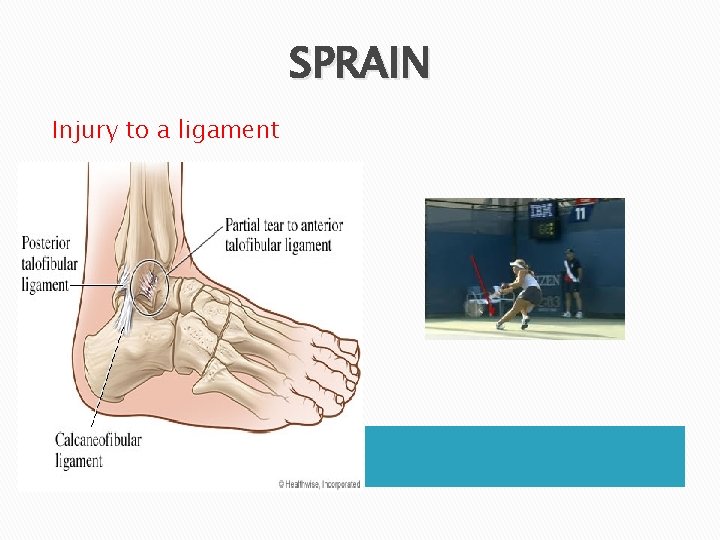 SPRAIN Injury to a ligament 