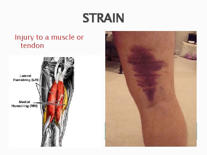 STRAIN Injury to a muscle or tendon 