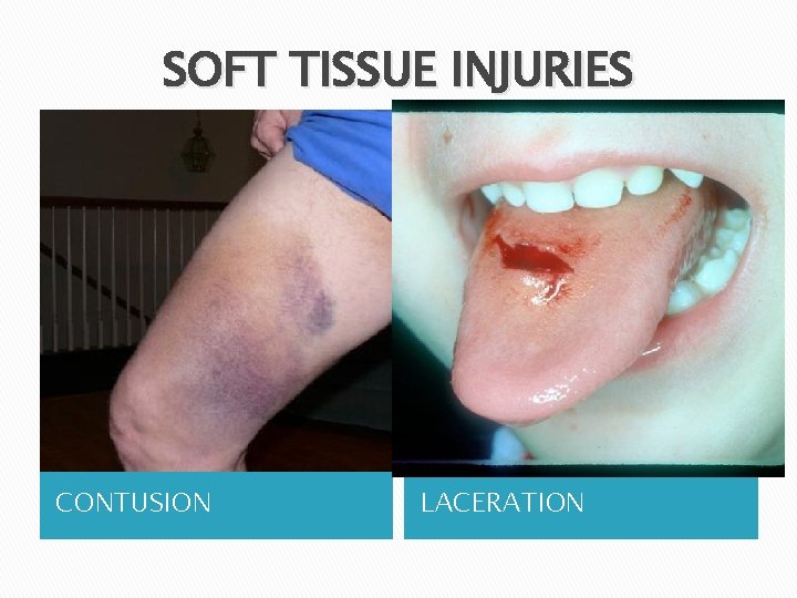 SOFT TISSUE INJURIES CONTUSION LACERATION 