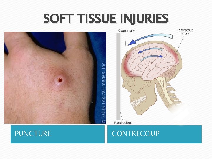 SOFT TISSUE INJURIES PUNCTURE CONTRECOUP 