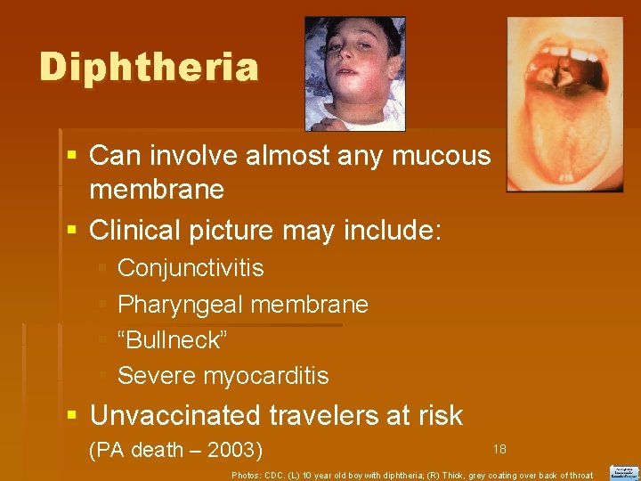 Diphtheria Can involve almost any mucous membrane Clinical picture may include: Conjunctivitis Pharyngeal membrane