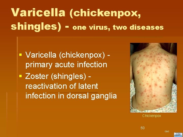 Varicella (chickenpox, shingles) - one virus, two diseases Varicella (chickenpox) - primary acute infection