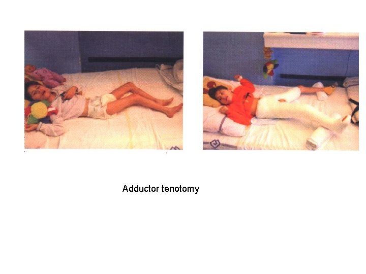 Adductor tenotomy 