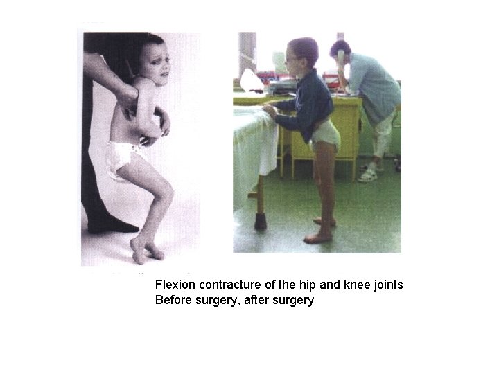 Flexion contracture of the hip and knee joints Before surgery, after surgery 
