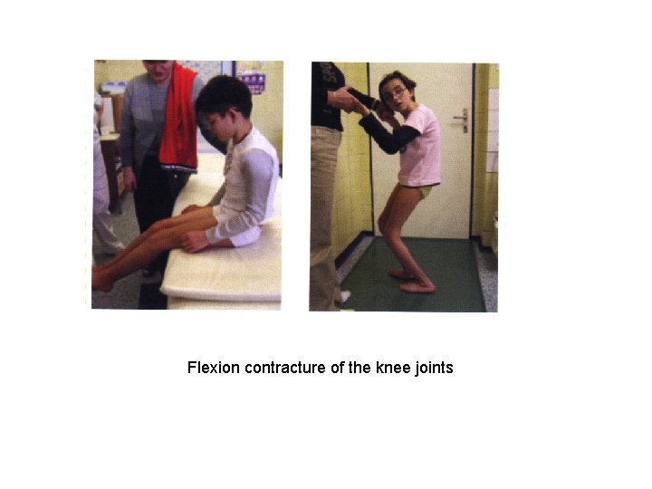 Flexion contracture of the knee joints 