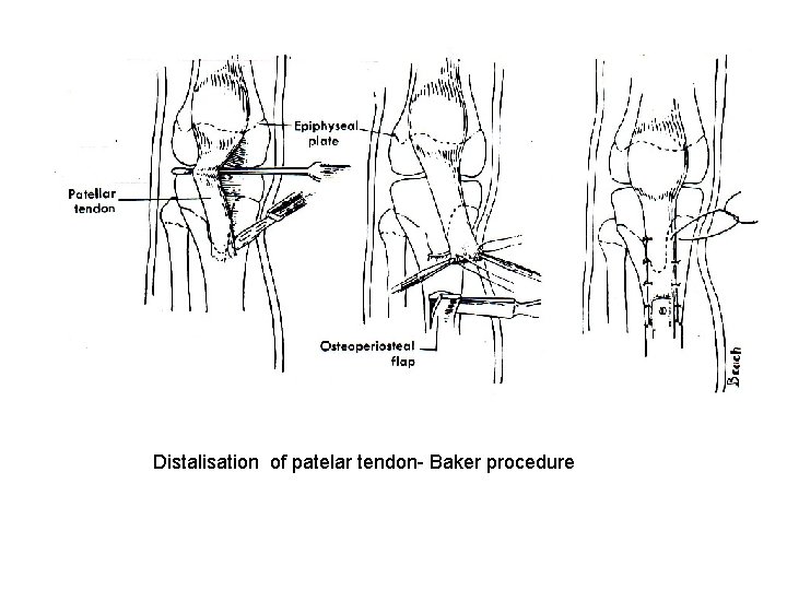 Distalisation of patelar tendon- Baker procedure 