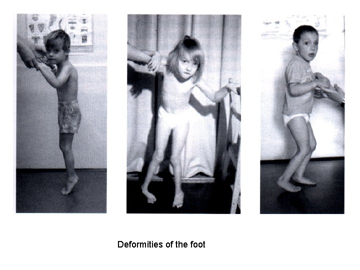 Deformities of the foot 