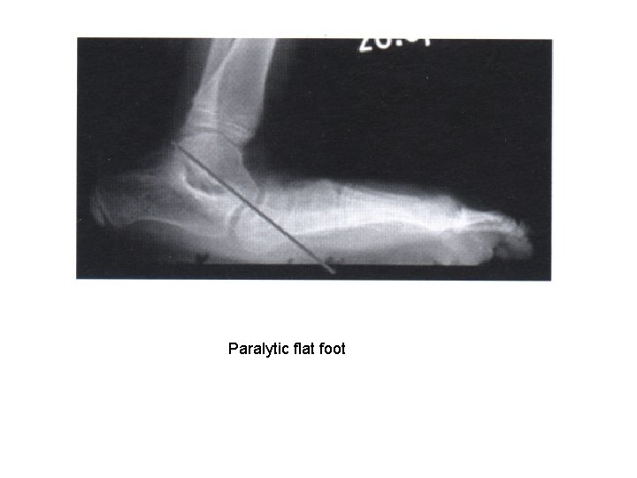 Paralytic flat foot 