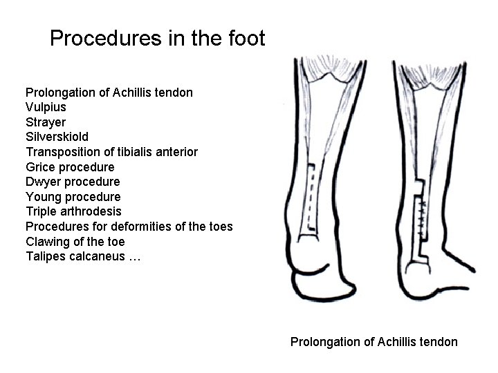 Procedures in the foot Prolongation of Achillis tendon Vulpius Strayer Silverskiold Transposition of tibialis