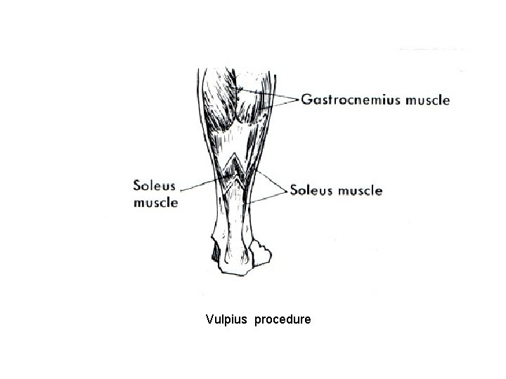 Vulpius procedure 