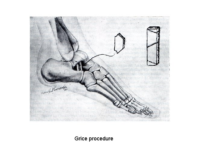 Grice procedure 