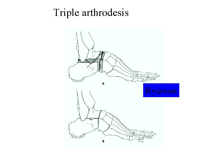 Triple arthrodesis Ryerson 