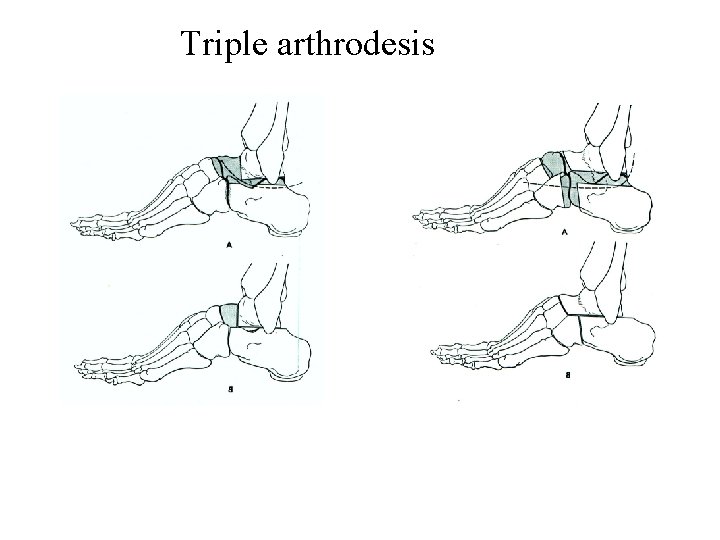 Triple arthrodesis 