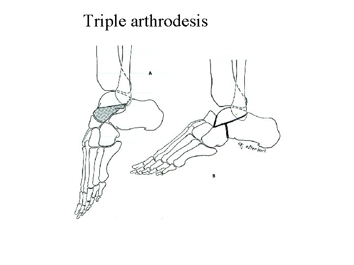 Triple arthrodesis 