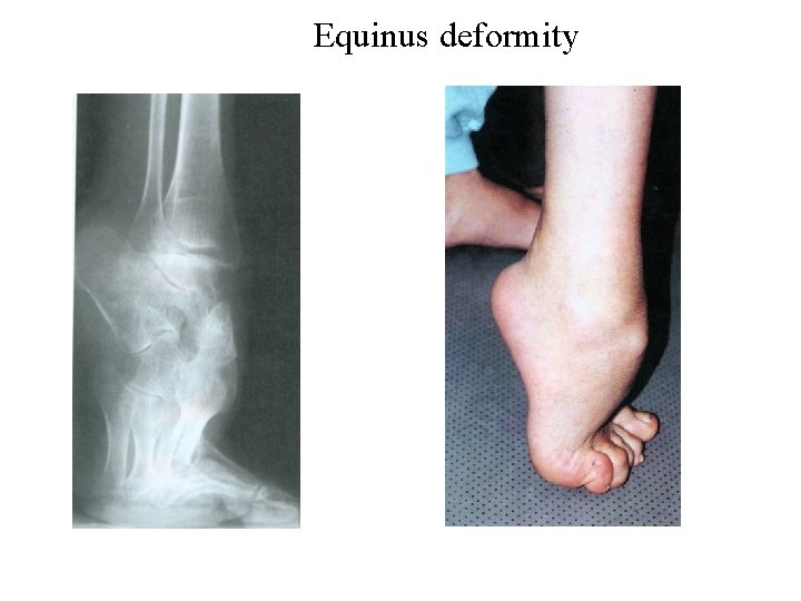 Equinus deformity 