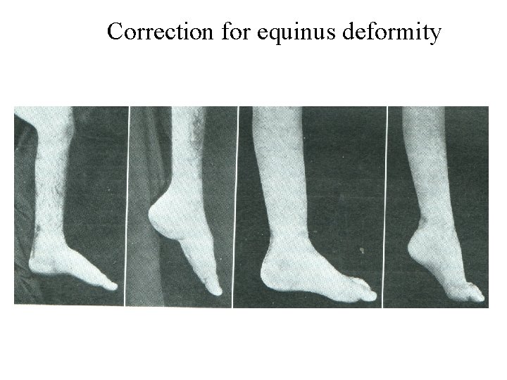 Correction for equinus deformity 