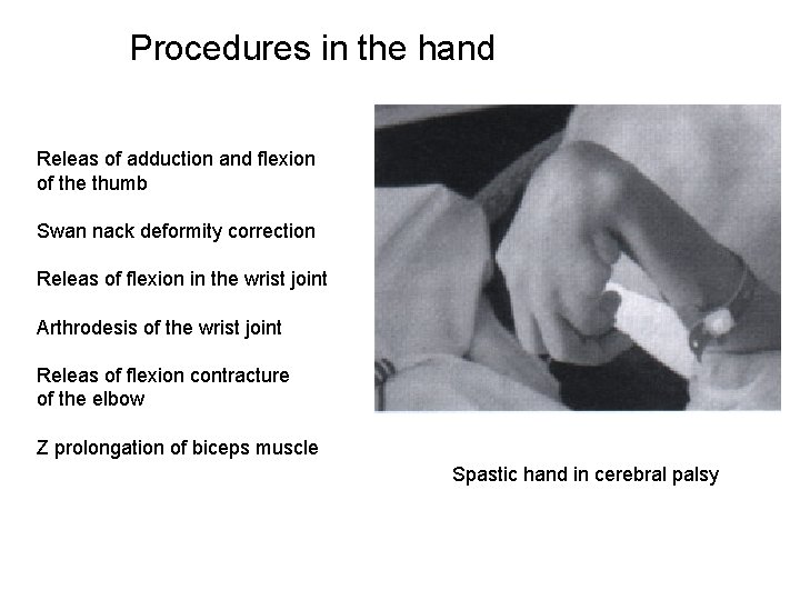 Procedures in the hand Releas of adduction and flexion of the thumb Swan nack