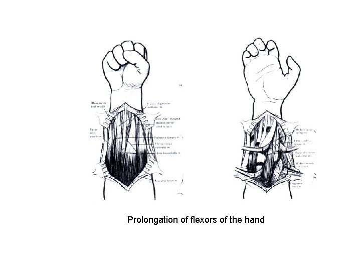 Prolongation of flexors of the hand 