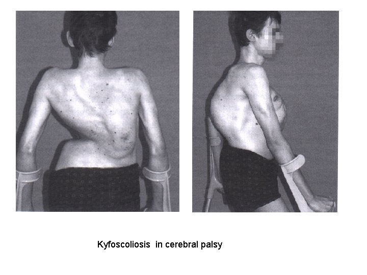 Kyfoscoliosis in cerebral palsy 