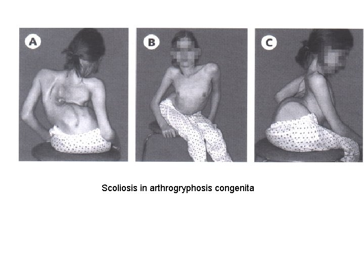 Scoliosis in arthrogryphosis congenita 