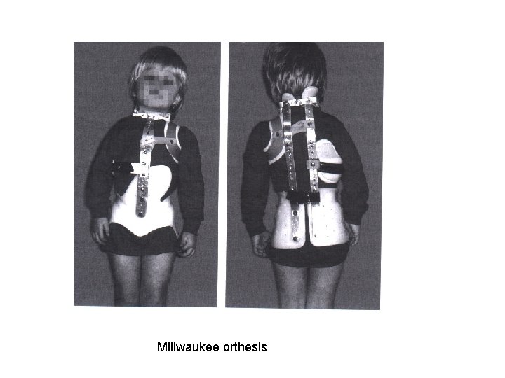 Millwaukee orthesis 